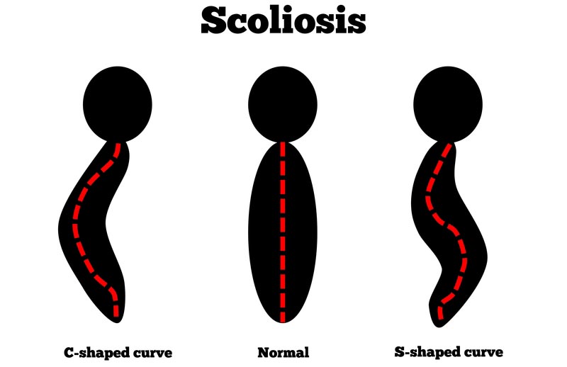 Rock Springs, WY scoliosis treatment